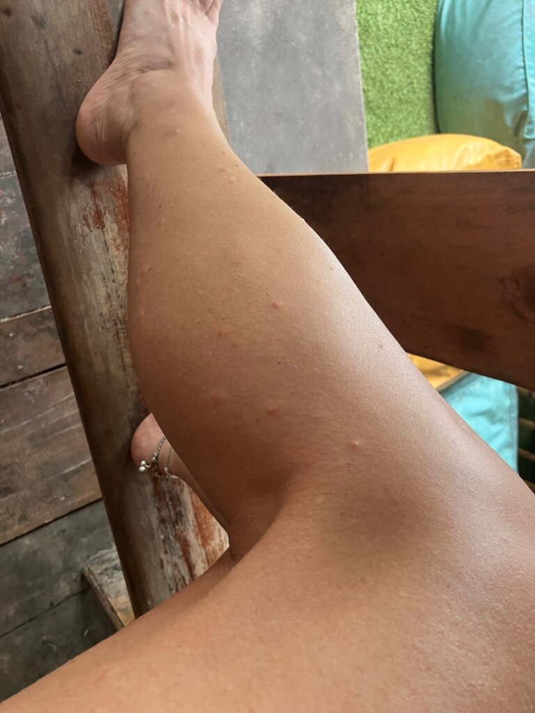 Thigh covered with sandfly bites