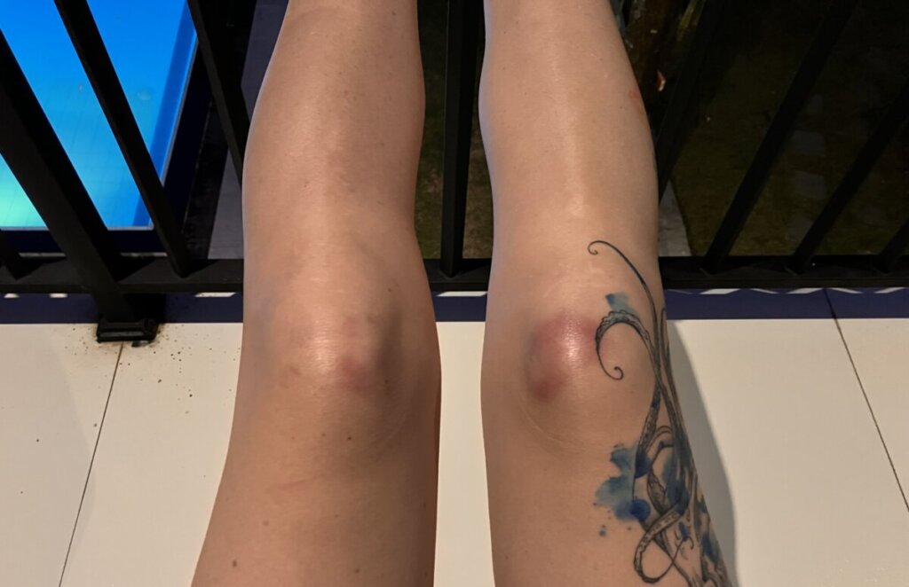 bruised knee caps from surf fins