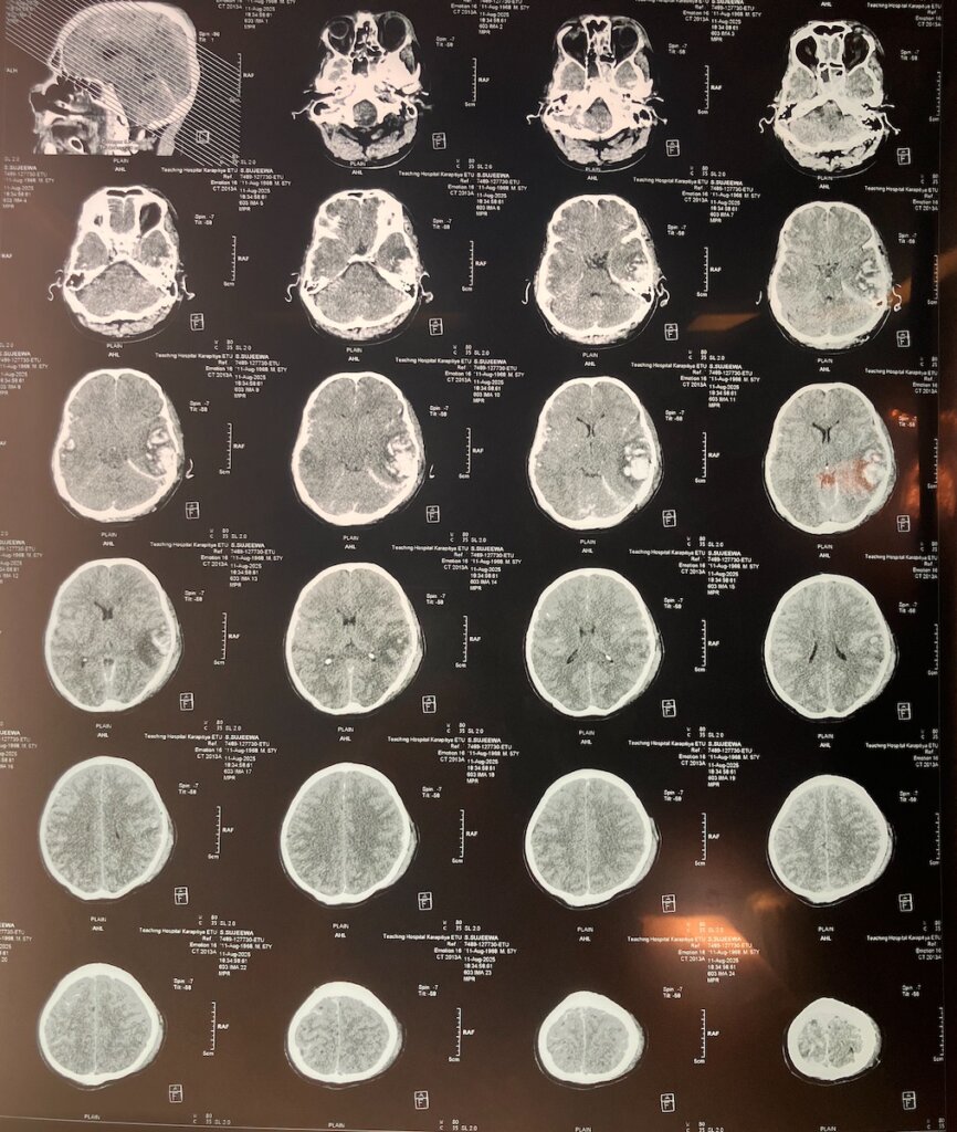 MRI images of brain injury