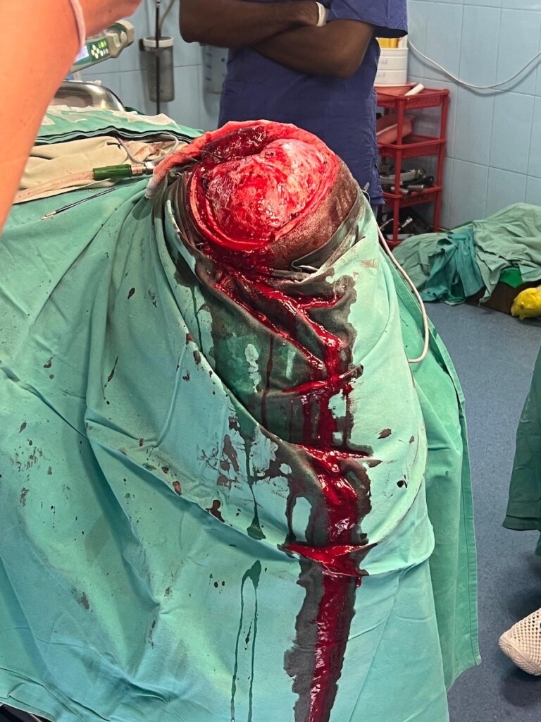 Hemicraniectomy