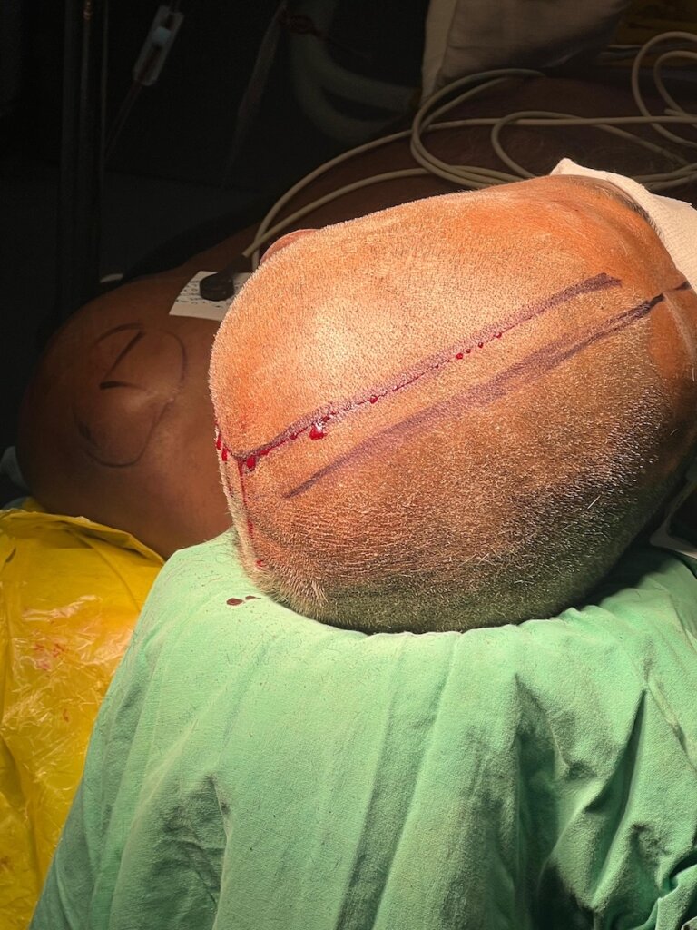 the skull of a human is marked with a ped for the incision line