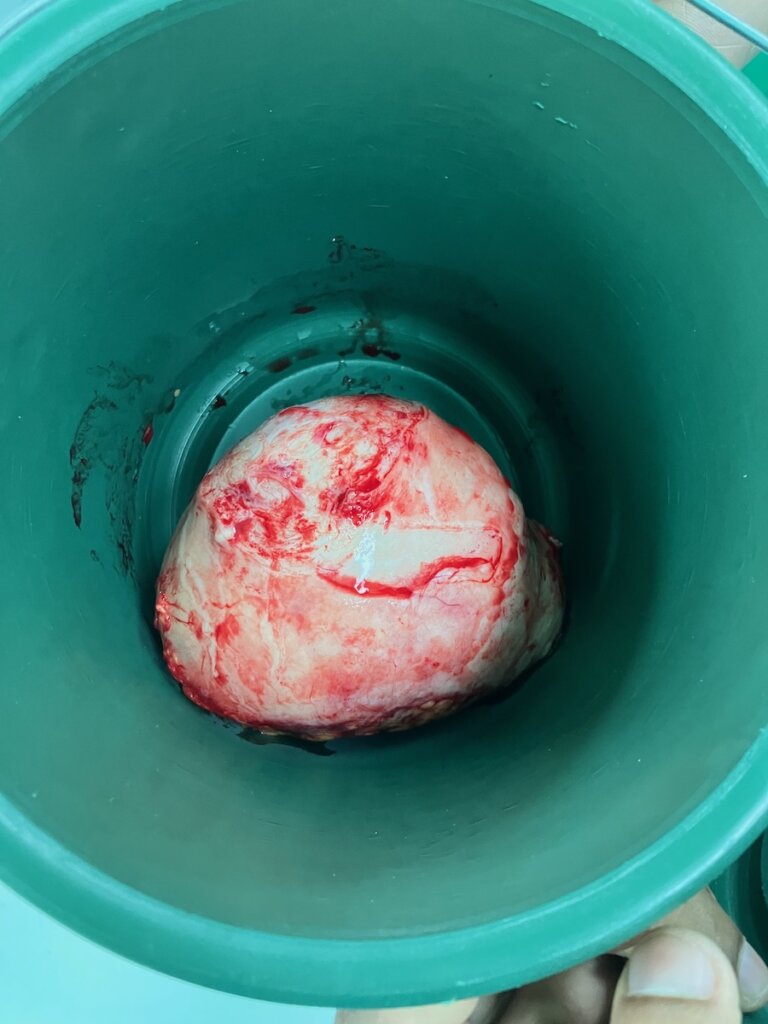 Mass dissected from a uterus